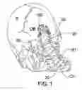 Fig. 02 - Minimal access occipital plate
