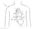 Fig. 01 - Blood clot removal device, system, and method
