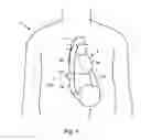 Fig. 02 - Blood clot removal device, system, and method