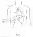 Fig. 08 - Blood clot removal device, system, and method