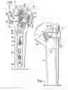 Fig. 02 - Expanded fixation of bones
