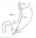Fig. 02 - Electrode assemblies, tools, and methods for gastric wall implantation