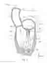 Fig. 02 - Catheter-based annuloplasty using ventricularly positioned catheter
