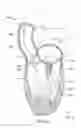 Fig. 07 - Catheter-based annuloplasty using ventricularly positioned catheter