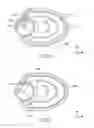 Fig. 09 - Catheter-based annuloplasty using ventricularly positioned catheter