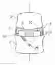 Fig. 01 - INTRADISCAL MOTION LIMITING MEMBER AND METHOD OF INSTALLATION THEREOF