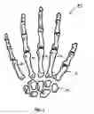 Fig. 02 - CARPOMETACARPAL JOINT SPACER