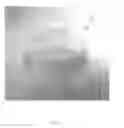 Fig. 03 - CARPOMETACARPAL JOINT SPACER