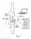 Fig. 02 - Sensing module having a piezo-resistive sensor for orthopedic load sensing insert device