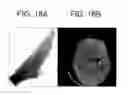 Fig. 13 - Advanced clustering method for material separation in dual energy CT