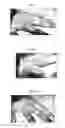 Fig. 03 - Therapeutic methods and pharmaceutical compositions for treating warts with tellurium compounds