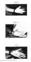 Fig. 04 - Therapeutic methods and pharmaceutical compositions for treating warts with tellurium compounds
