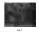 Fig. 08 - Methods of making enhanced, autologous fat grafts