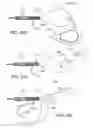 Fig. 45 - System for endoscopic suturing