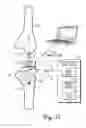 Fig. 05 - Dual mode closed-loop system and method for measuring a parameter of the muscular-skeletal system