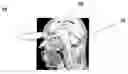 Fig. 01 - GAMMA PROBE DETECTION OF AMYLOID PLAQUE USING  RADIOLABELED A-BETA BINDING COMPOUNDS