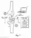 Fig. 02 - Sensing module for orthopedic load sensing insert device
