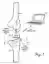 Fig. 02 - SENSING DEVICE AND METHOD FOR AN ORTHOPEDIC JOINT