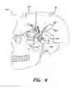 Fig. 09 - Treatment of movement disorders by brain stimulation