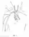 Fig. 02 - Proximally trimmable catheter including pre-attached bifurcation and related methods