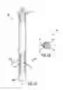 Fig. 02 - Bone rifling system and method of preparing a bone using such system