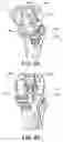Fig. 35 - Methods and apparatus for performing knee arthroplasty