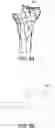 Fig. 43 - Methods and apparatus for performing knee arthroplasty