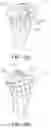 Fig. 49 - Methods and apparatus for performing knee arthroplasty