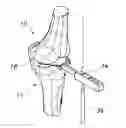 Fig. 01 - Methods and apparatus for performing knee arthroplasty
