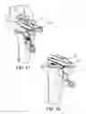 Fig. 41 - Methods and apparatus for performing knee arthroplasty