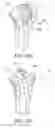 Fig. 49 - Methods and apparatus for performing knee arthroplasty