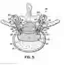 Fig. 06 - Bone anchor system