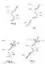Fig. 06 - Subcardiac threshold vagal nerve stimulation