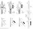 Fig. 02 - METHOD FOR FILTERING EMBOLIC MATERIAL