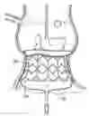 Fig. 01 - Unitary quick connect prosthetic heart valve and deployment system and methods