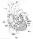 Fig. 02 - Unitary quick connect prosthetic heart valve and deployment system and methods