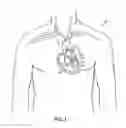 Fig. 02 - Device and method for improving the function of a heart valve