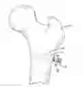 Fig. 01 - SCREW THREAD PLACEMENT IN A POROUS MEDICAL DEVICE