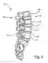 Fig. 06 - Bone fusion device and methods