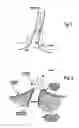 Fig. 02 - Method of installing a transcutaneous prosthesis