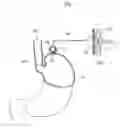 Fig. 02 - Device for treating obesity