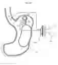 Fig. 15 - Device for treating obesity