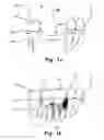 Fig. 02 - COMPUTER IMPLEMENTED PLANNING AND PROVIDING OF MASS CUSTOMIZED BONE STRUCTURE