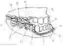 Fig. 01 - DEVICE FOR MANDIBULAR ADVANCEMENT
