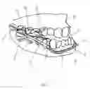 Fig. 03 - DEVICE FOR MANDIBULAR ADVANCEMENT
