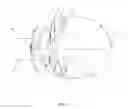 Fig. 03 - Intraoccular implant system with external lens and mirrors