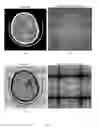 Fig. 06 -  Method and System of Segmenting CT Scan Data