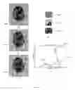 Fig. 22 -  Method and System of Segmenting CT Scan Data