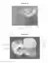 Fig. 10 - INDIRECT RESTORATION PLACEMENT TOOL AND PROCESS