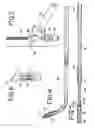 Fig. 03 - Methods and apparatus for intraocular brachytherapy